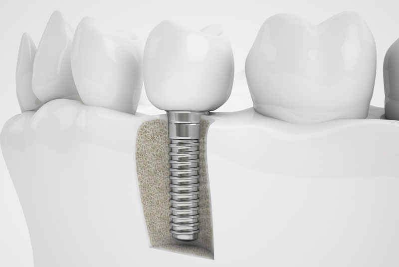 an image of a dental implant model showing where a bone grafting procedure was performed. a dental implant is in the place where the bone grafting procedure happened.