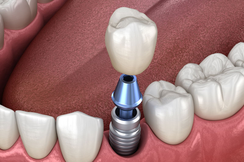 a graphic image of a dental implant post being placed in a jawbone, along with the abutment and crown on top, where it will benefit the patients jawbone health.