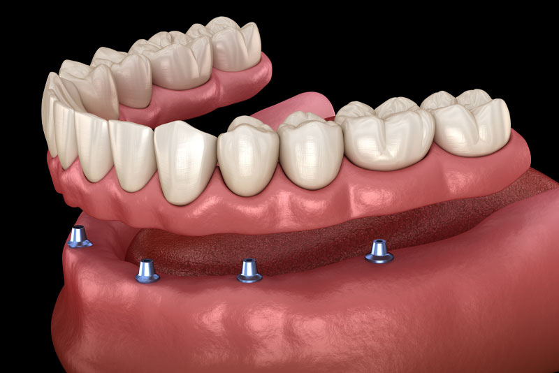 an image of a lower arch implant supported denture model showing how the dental implant posts benefit the patient by stabilizing the denture.